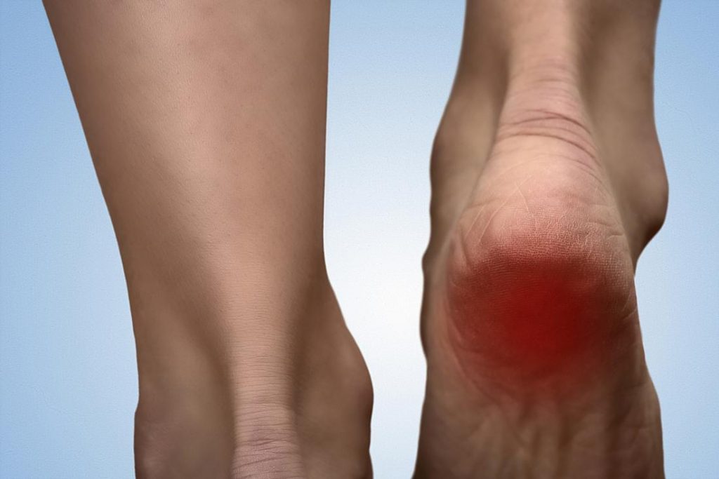 heel-spurs