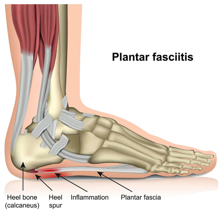 http://plantar-fasciitis
