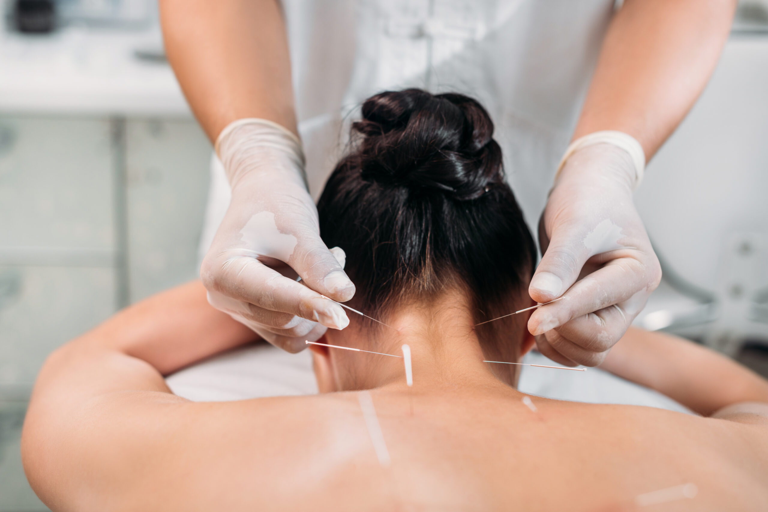 acupuncture therapy