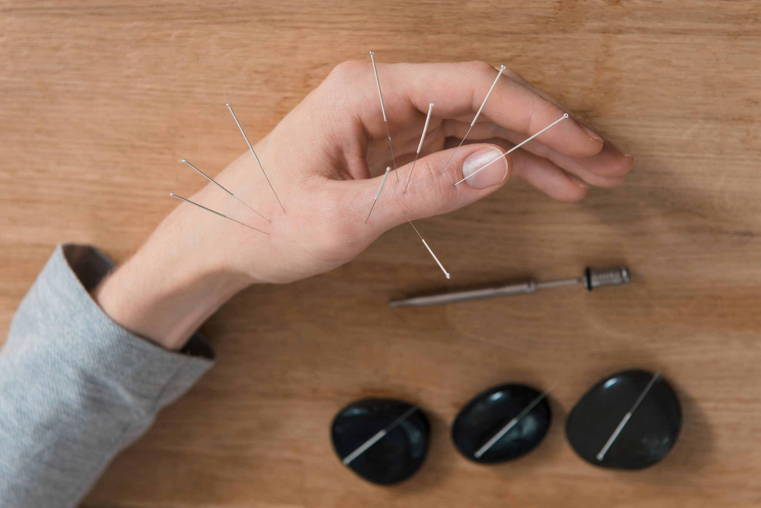 Impact of Acupuncture on Mental Health