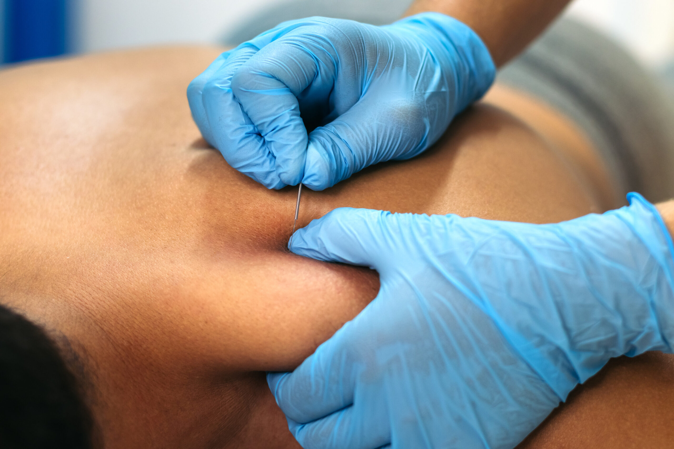 What is Dry Needling Therapy?