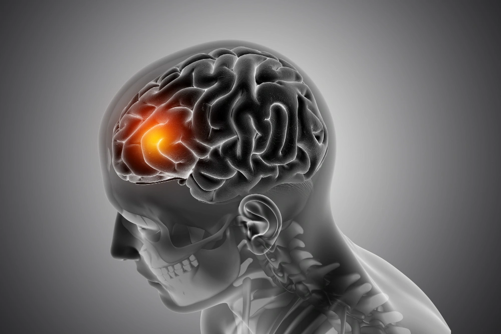 http://Concussion