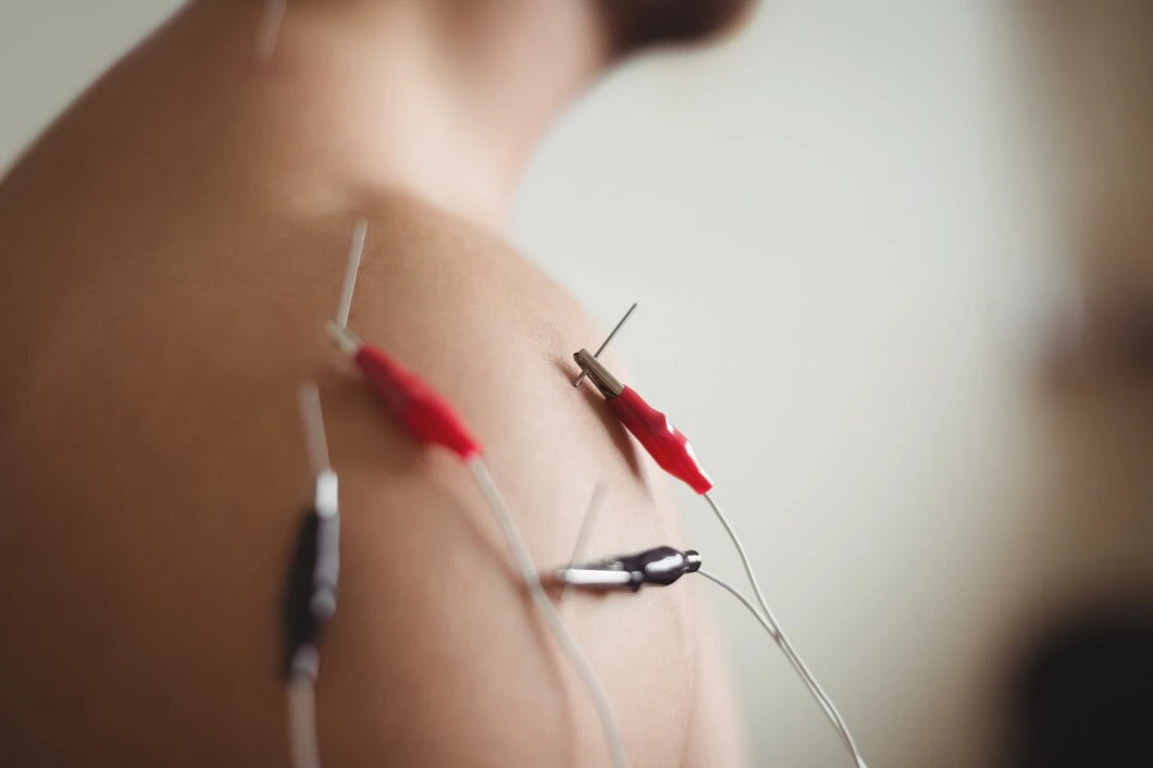 TENS Therapy